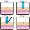 Skin Tag Removal Device, Mole Removal, Corn Removal